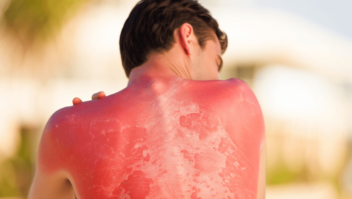 Comment soulager rapidement un coup de soleil ?