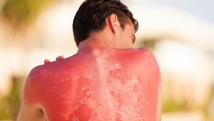 Comment soulager rapidement un coup de soleil ?