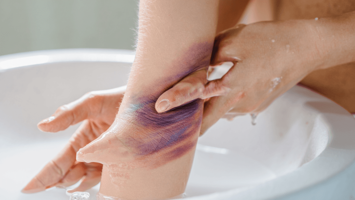 Médecine Générale – 23 janv. 2023Hématome : comment le faire disparaître ?Vous constatez l'apparition d'hématomes sur votre peau ? Nos médecins vous expliquent leurs causes, complications, et comment les traiter.En savoir plus